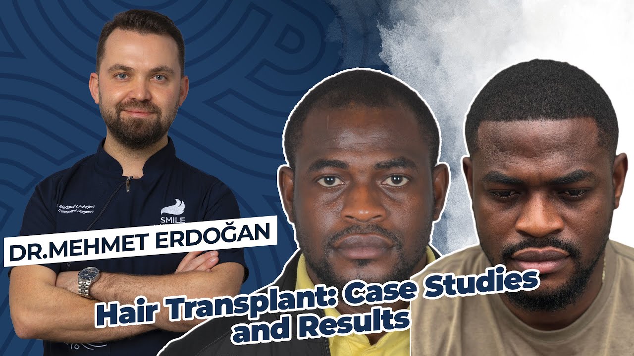 1-Year Results & Hairline Transformation Revealed | Dr.Mehmet Erdogan's Hair Transplant Case Studies