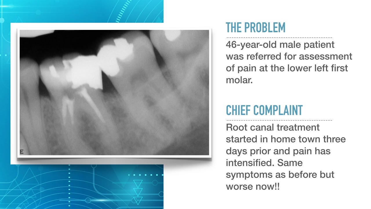 Advances in Endodontic Treatment: Part 1--Diagnosis and Treatment Planning