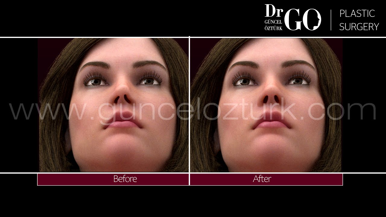 Opération de rhinoplastie avec technique de préservation du nez 