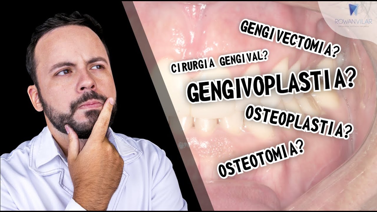 GENGIVOPLASTIA? GENGIVECTOMIA? CIRURGIA GENGIVAL? SAIBA A DIFERENÇA!!! #drrowanvilar