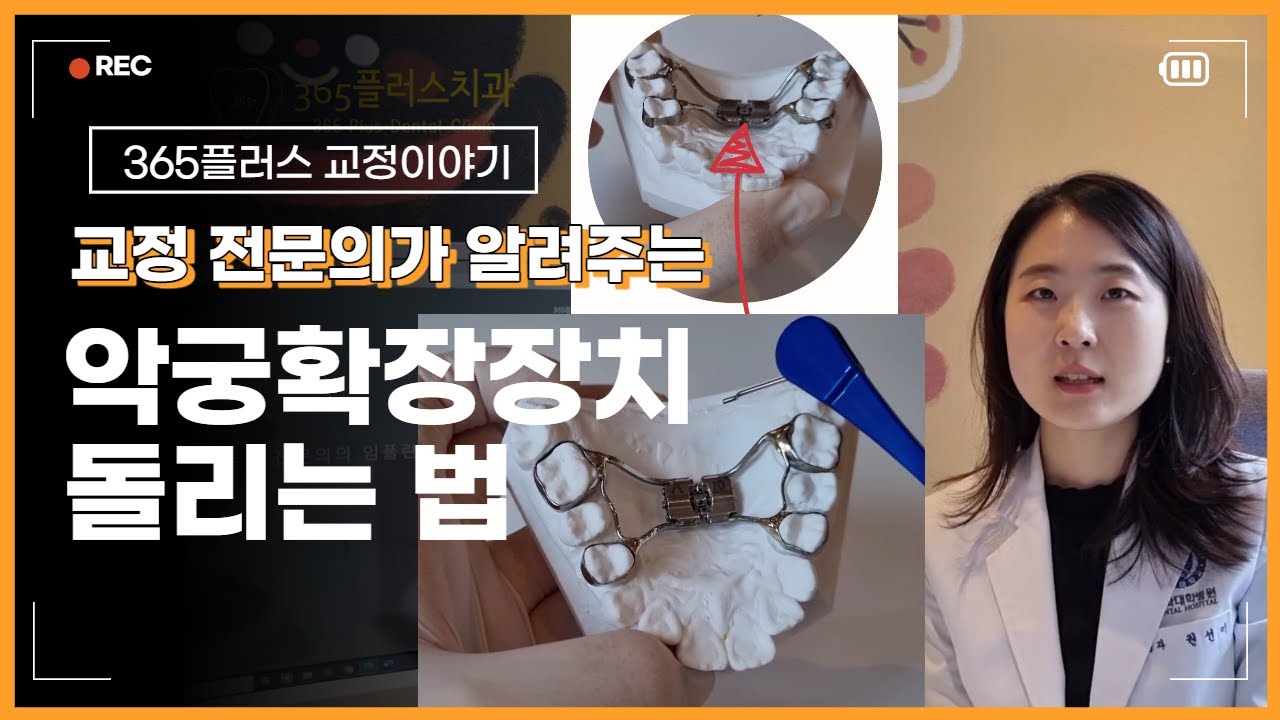 악궁확장장치 돌리는 법 I 교정과 전문의가 직접 알려줌 I How to activate Rapid palatal Expander(RPE)