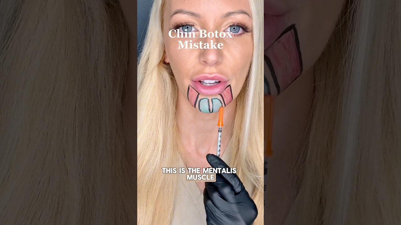 Chin Botox Mistake ❌💉