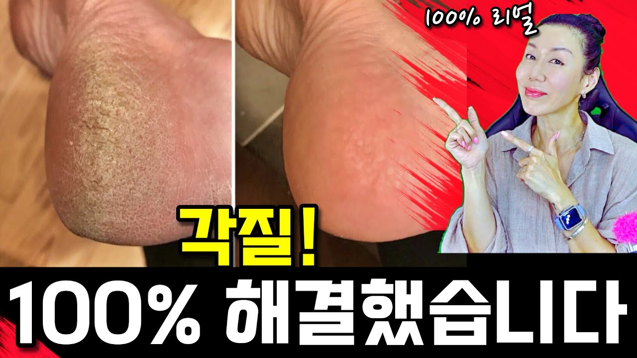 리얼체험) 더이상 밀고, 깎고, 문지르지 마세요. 발뒤꿈치 굳은살, 각질, 별짓 다해보다 드디어 100% 아가발 만들었어요.