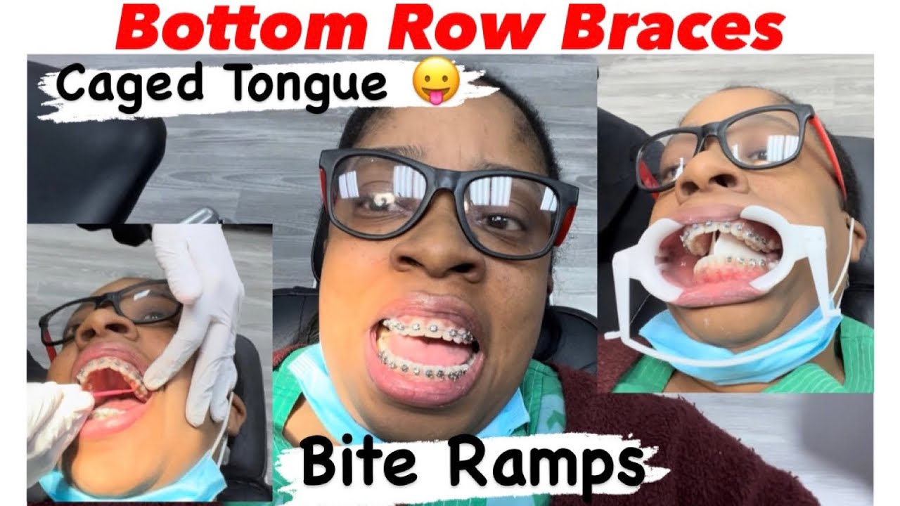 Bottom Row Braces, Caged Tongue & Bite Ramps | Braces 😬 Vlog | Smile Doctors