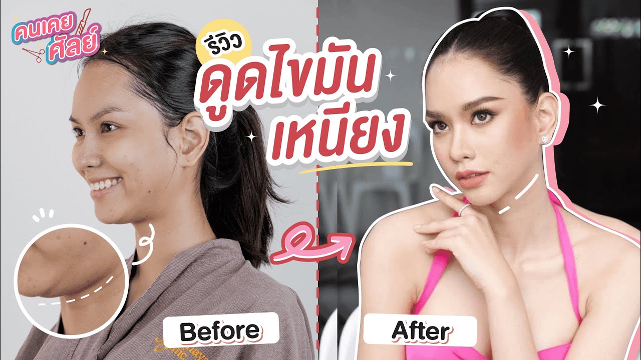 คนเคยศัลย์ แชร์ประสบการณ์ดูดไขมันเหนียง ดูดไขมันหน้า หน้าเรียวถาวร ?