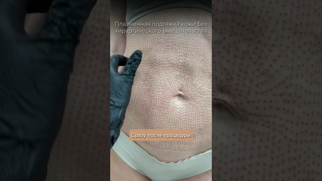 Подтянем и уберем обвисшую кожу в студии Skin Up👌🏻