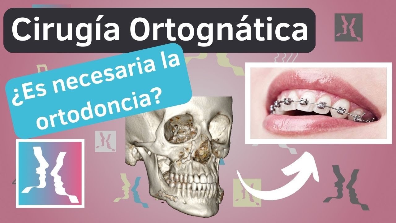 Es necesario el tto. de ortodoncia para una cirugía ortognática?