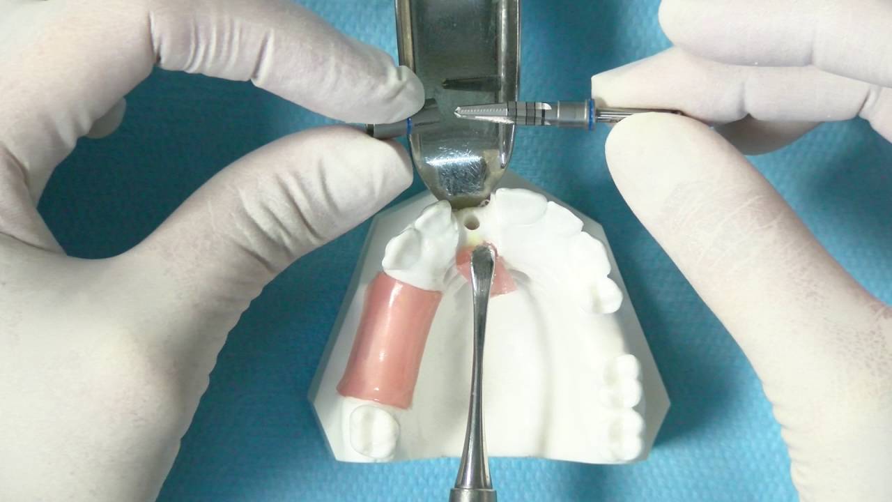 Topes oclusales - implantología oral