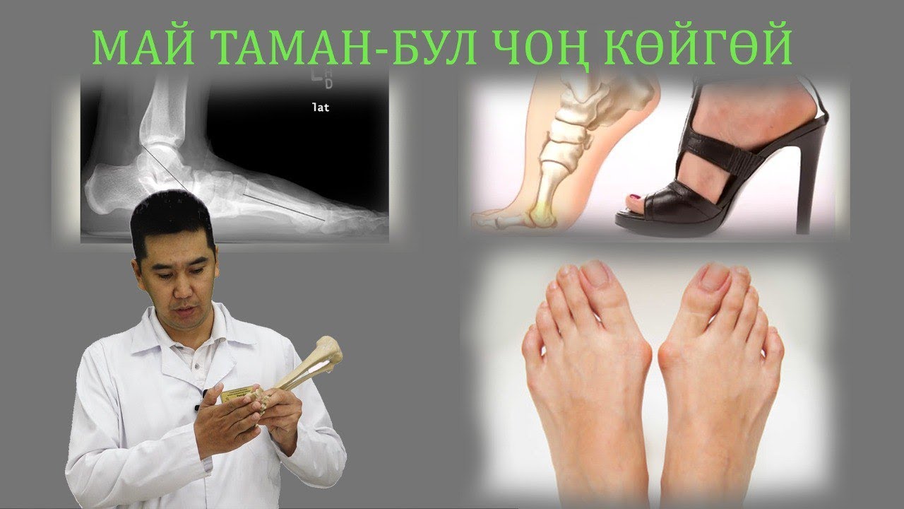 Май таман кандай оору?#плоскостопие #ортопедНурбекРыскулов