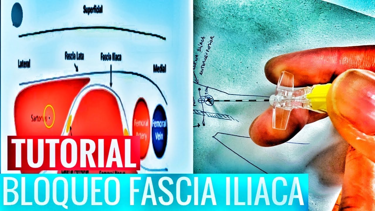 Tutorial bloqueo fascia iliaca