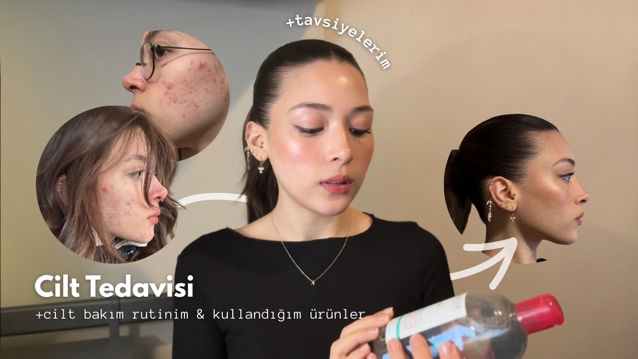 Cilt Tedavi S&uuml;recim💊| fotoğraflar ile tedavinin tamamı & aknetrent