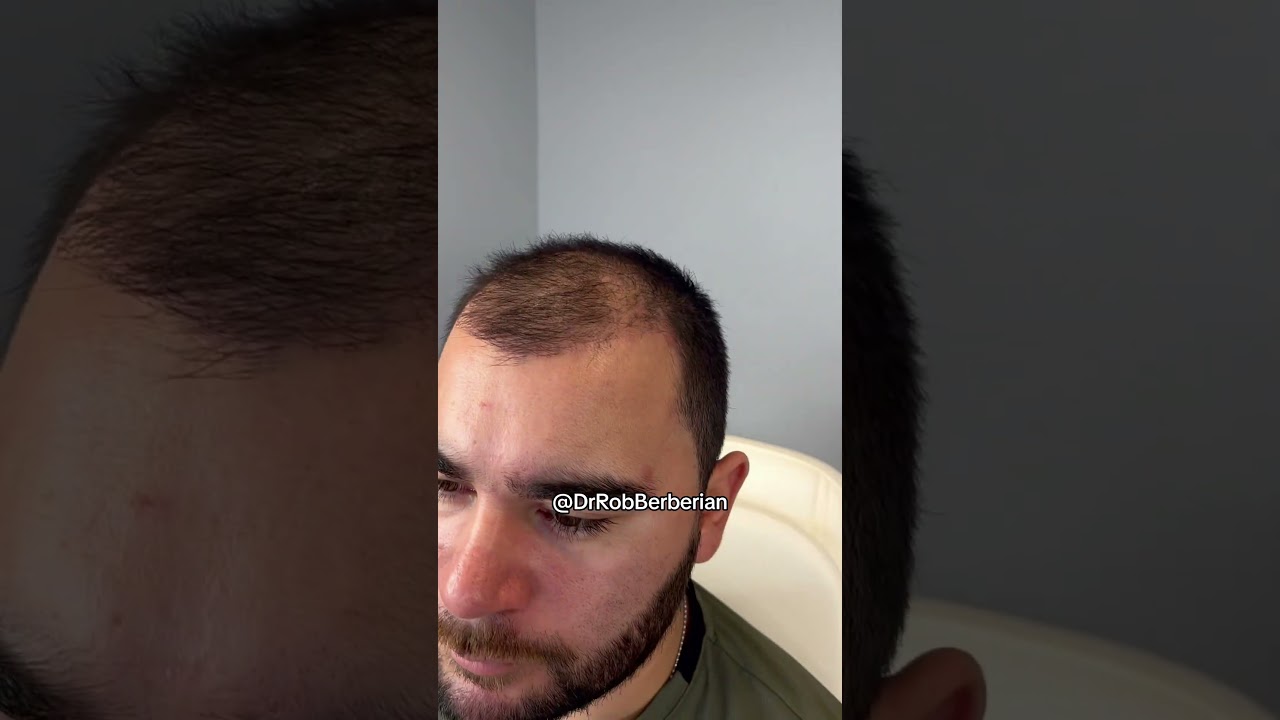 30 days post FUE hair transplant with PRP in Los Angeles & Newport Beach by Dr. Rob Berberian