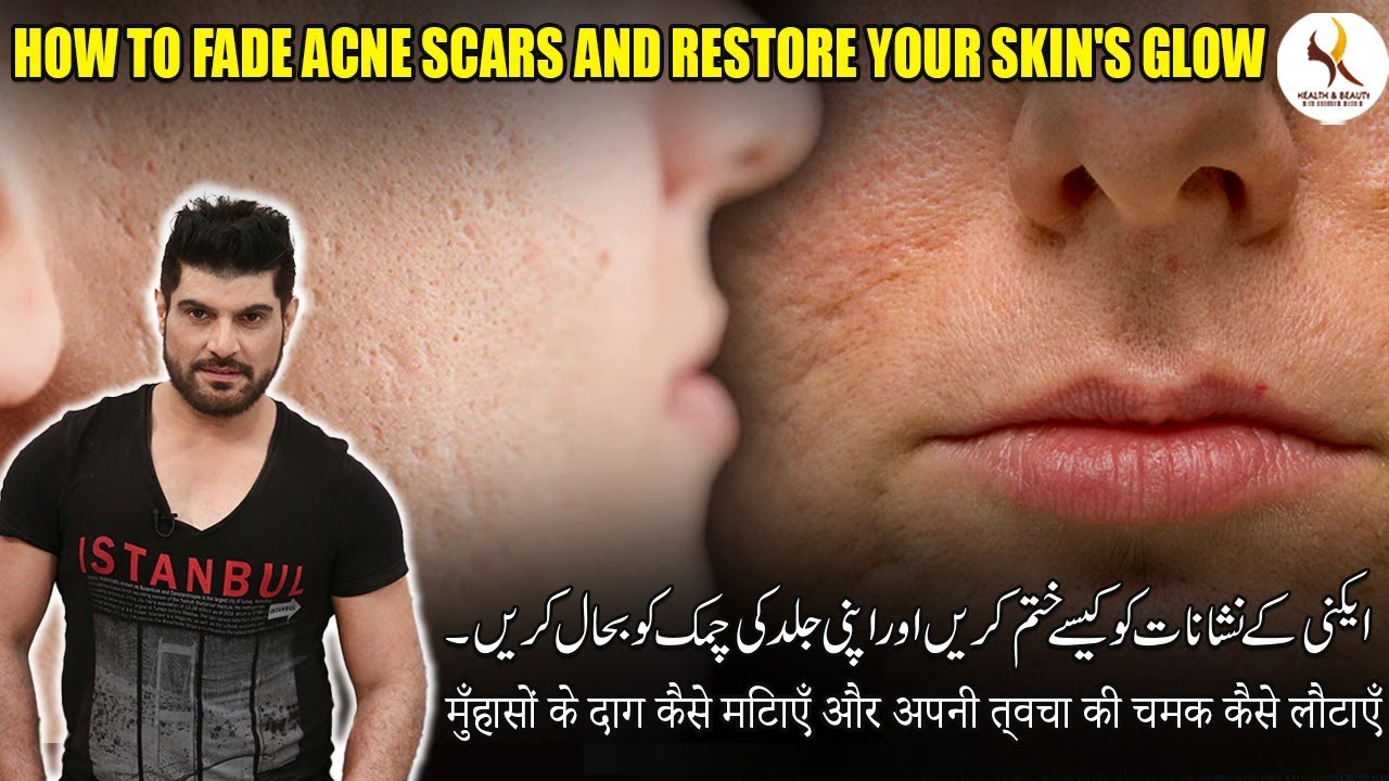 How to Fade Acne Scars and Restore Your Skin's Glow | Health & Beauty with Khurram Mushir