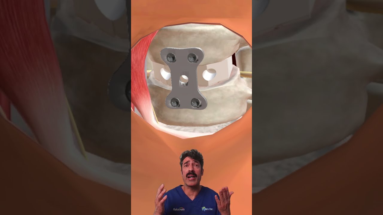 Como se tarta una HERNIA de DISCO cervical con cirugía DISECTOMIA #fisiolution