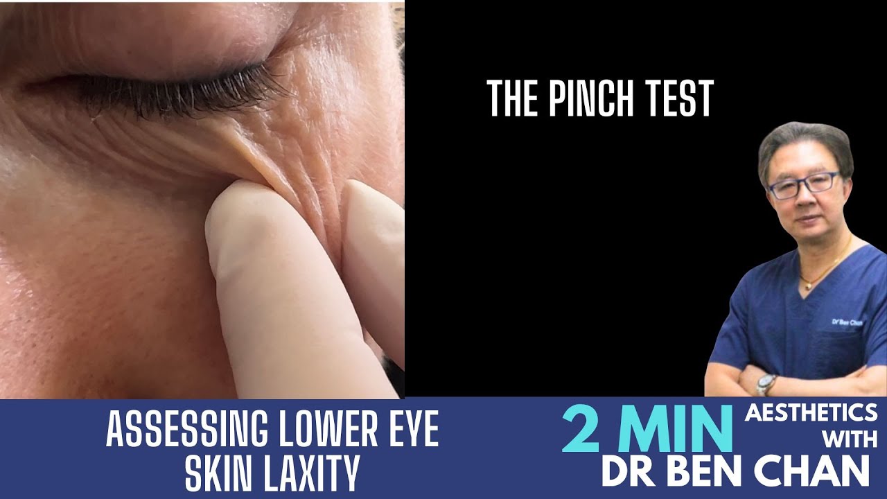 Lower eye skin laxity. The pinch test
