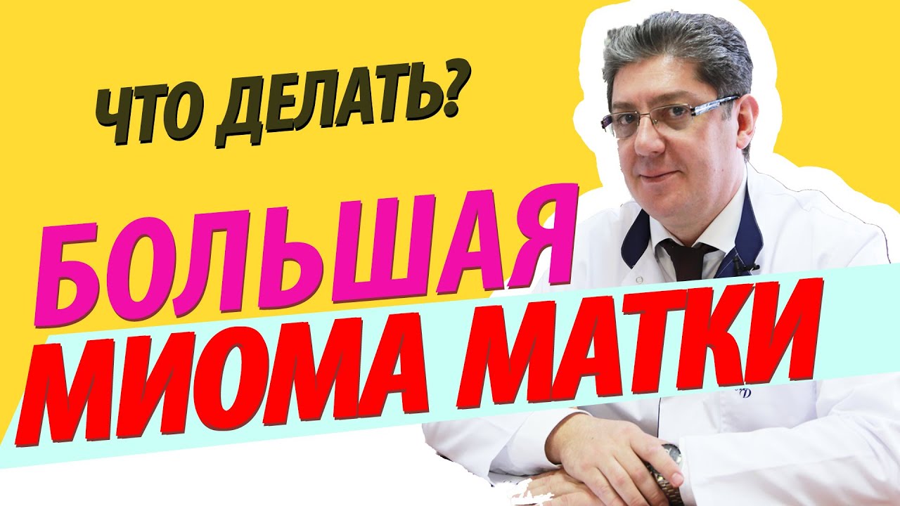 Большая миома матки (большой миоматозный узел)