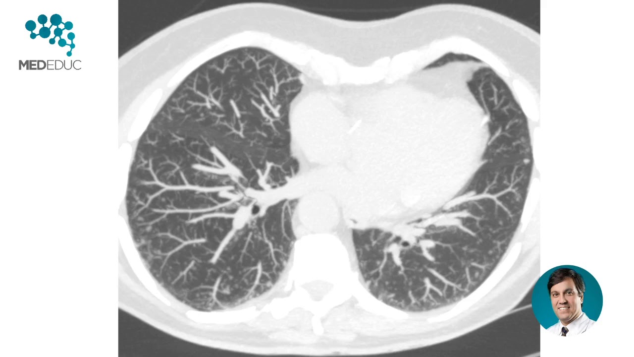Micronodulos Pulmonares