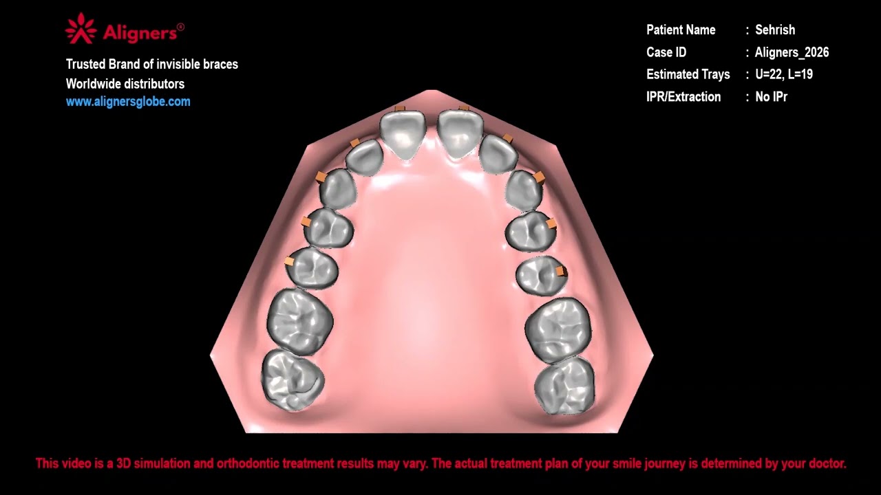 Orthodontics |  3D virtual setup of Treatment Planning | Aligners