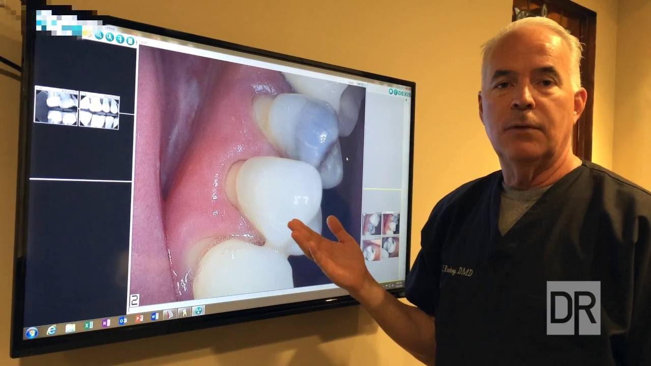 Case Study - Receding Gums and Silver Fillings, by Dana Rockey, Newport Beach Integrative Dentist