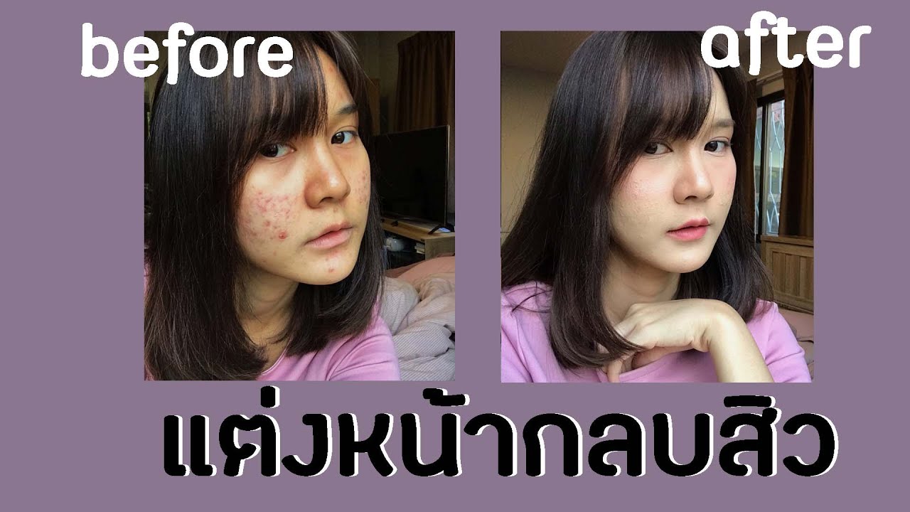 How to #แต่งหน้ากลบสิว ไม่หนาเตอะ ไม่อุดตัน แต่งได้ทุกวันจนกว่าสิวจะหาย l This is Pear
