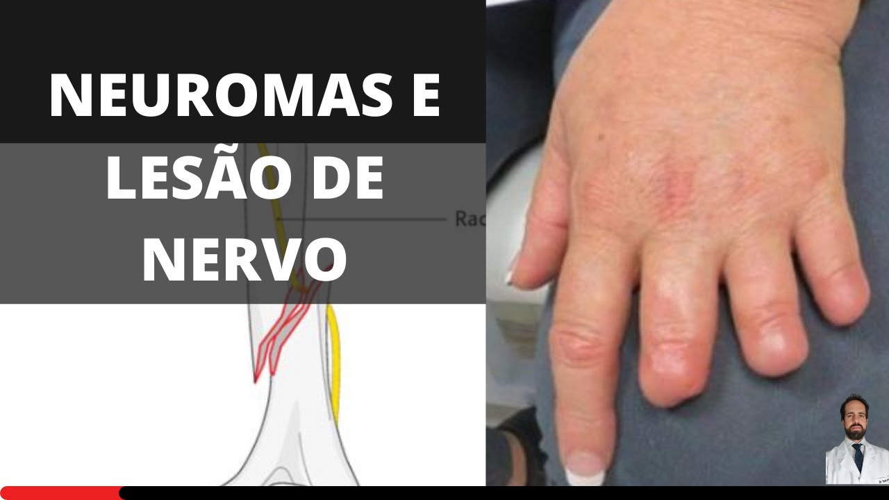 NEUROMAS -  O que é e como tratar?