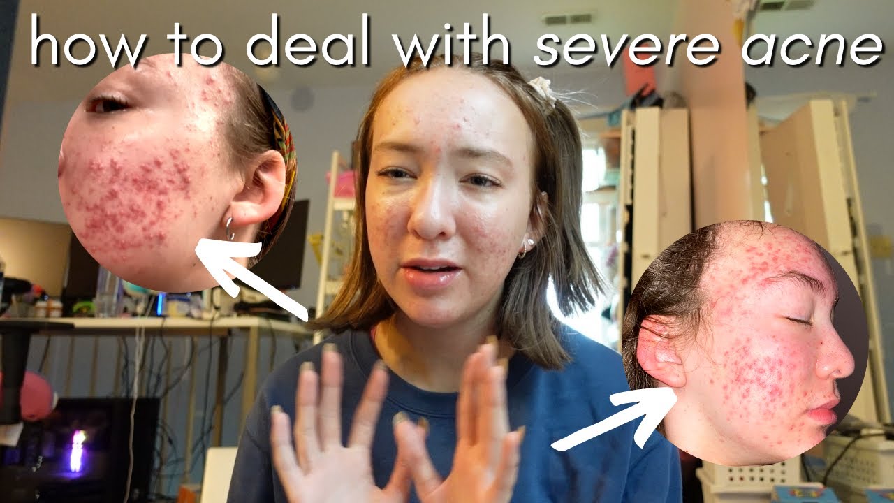 HOW TO DEAL WITH SEVERE ACNE (confidence, mindset, self worth)