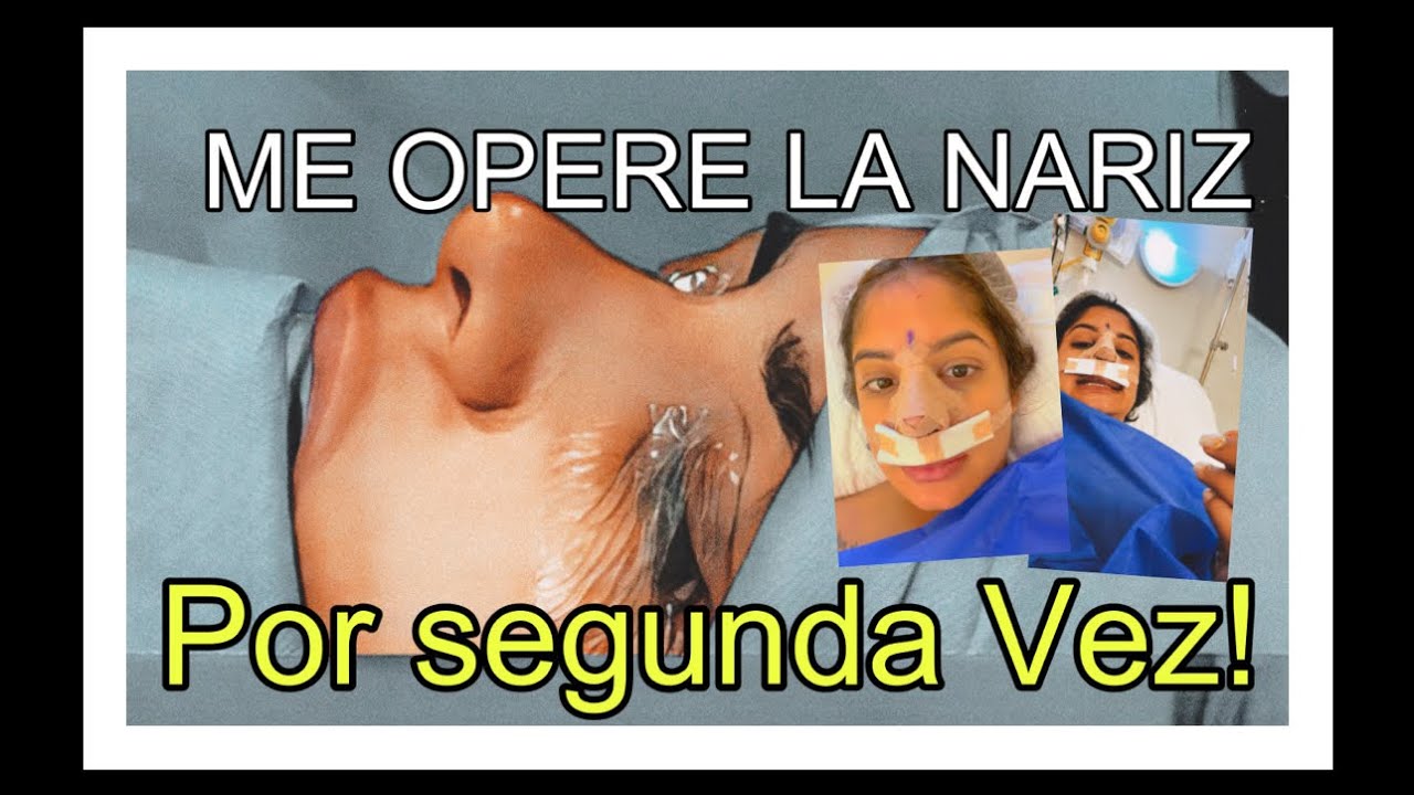 Me opere la nariz, por segunda vez!