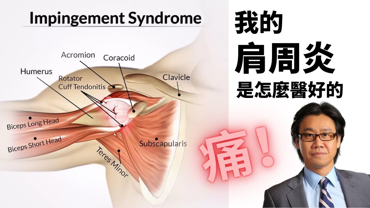 肩周炎（五十肩）治療過程：深圳港大醫院一針搞掂！