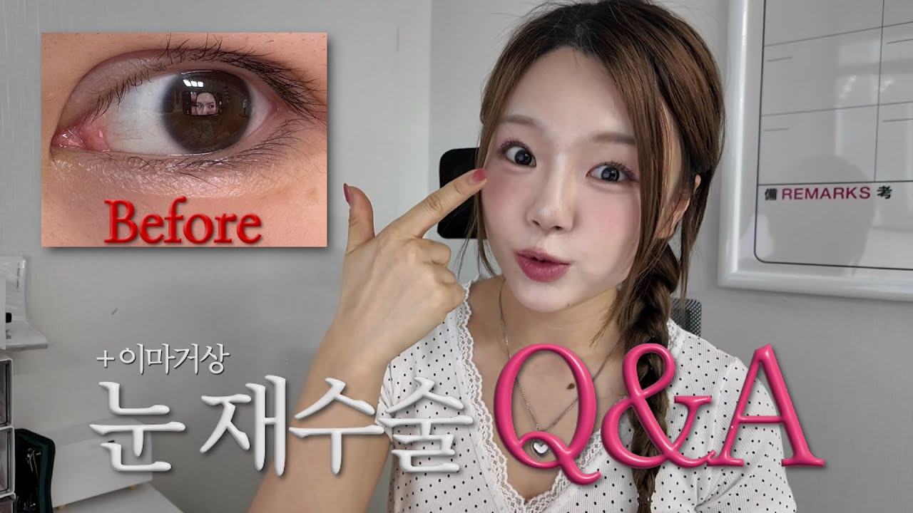 눈 재수술+이마거상 Q&A 다 알려드릴게 👀✨
