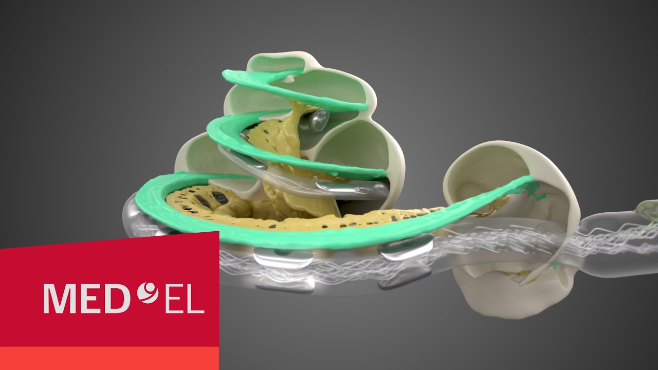 Cochlea-Implantat-Elektroden, die jeden Ton am richtigen Ort stimulieren