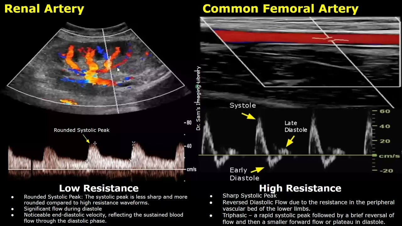 Difference Between Low Resistance & High Resistance Waveforms On Spectral Doppler Ultrasound USG