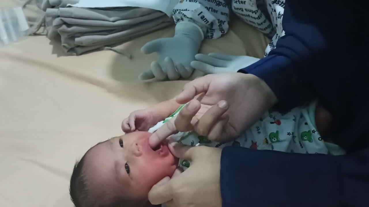 Adek Attamami Senam Lidah Pasca Tindakan Frenotomi