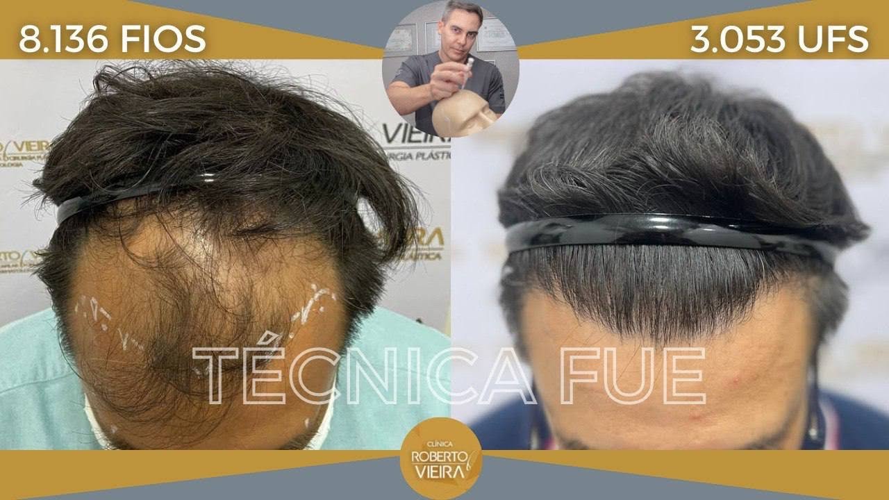 Evolução doze meses Transplante Capilar🔥