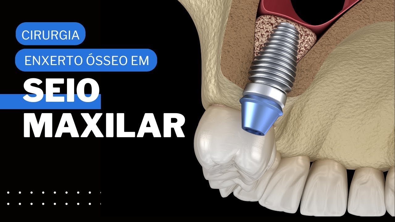 ENXERTO ÓSSEO EM SEIO MAXILAR