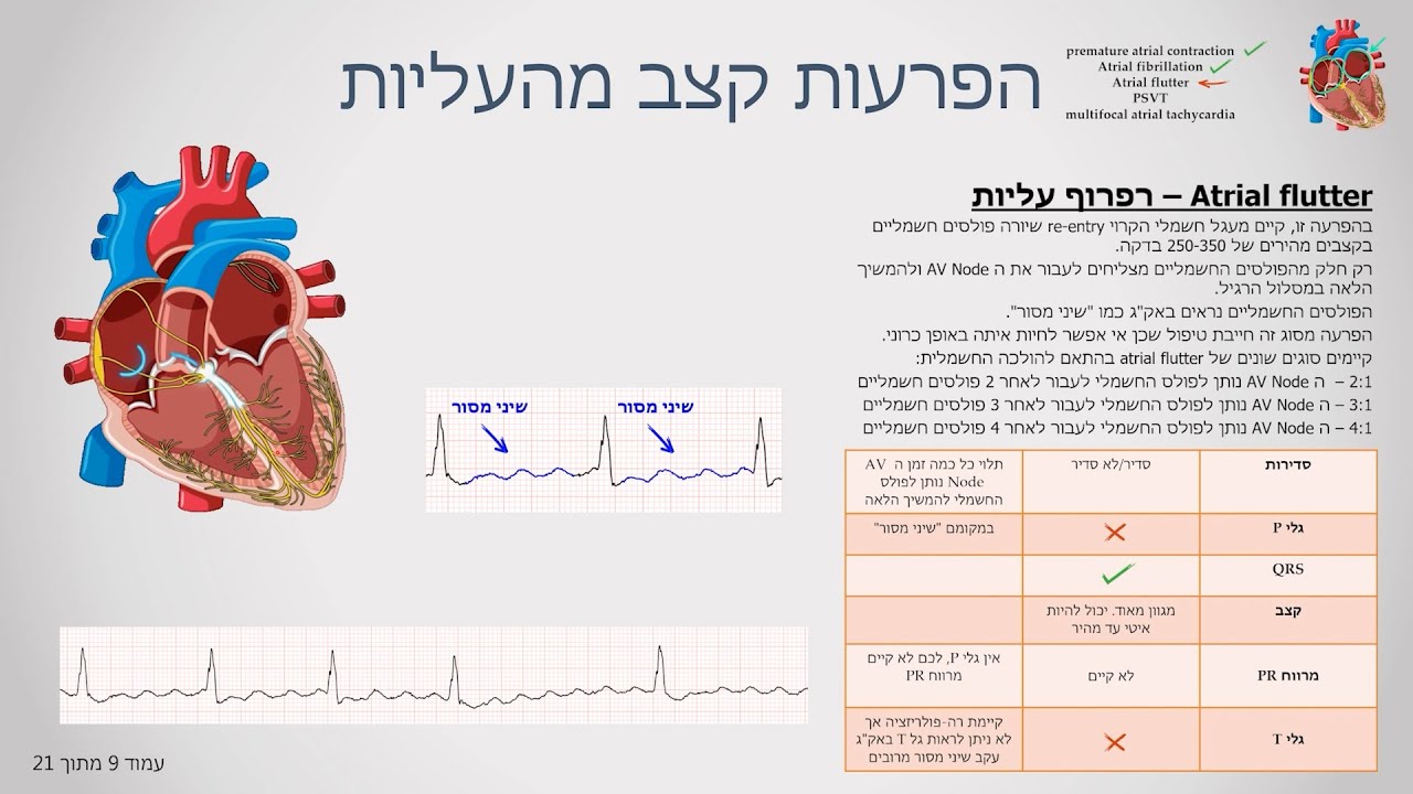 הפרעת קצב רפרוף עליות - atrial flutter באק"ג