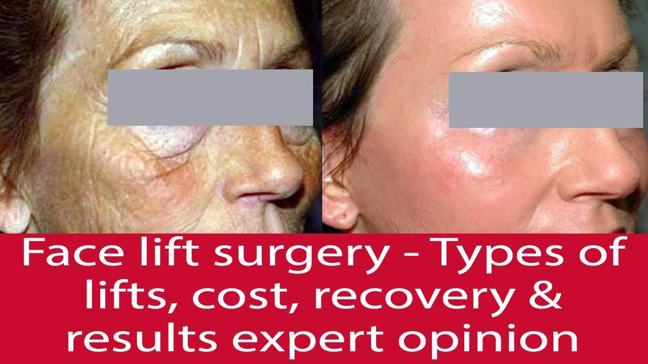 Face Lift Surgery – Types of Lifts, Cost, Recovery & Results | Dr. Debraj Shome