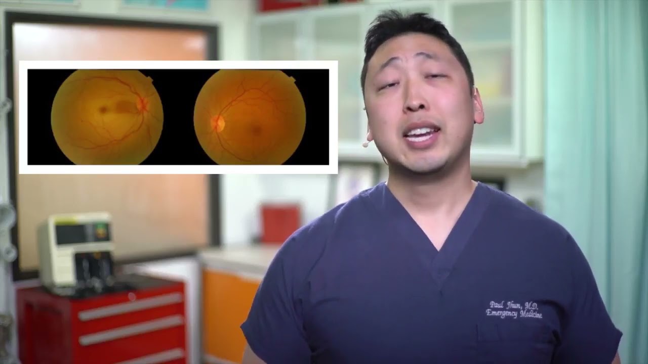 Central Retinal Artery Occlusion and Ocular Massage