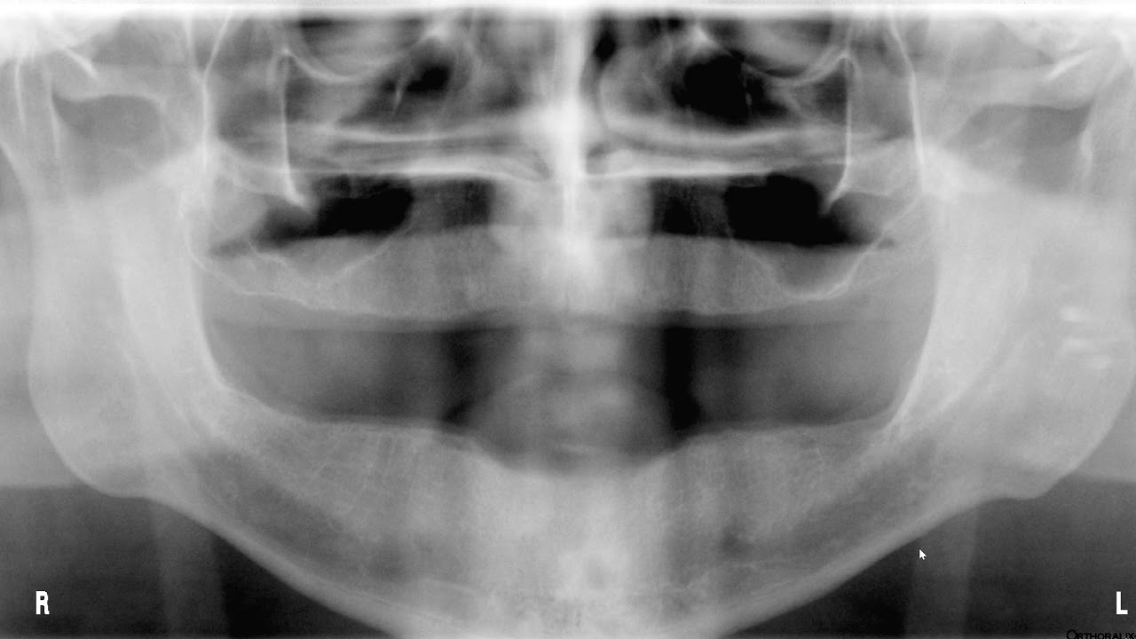 Quiz linear radiopacity on panoramic image