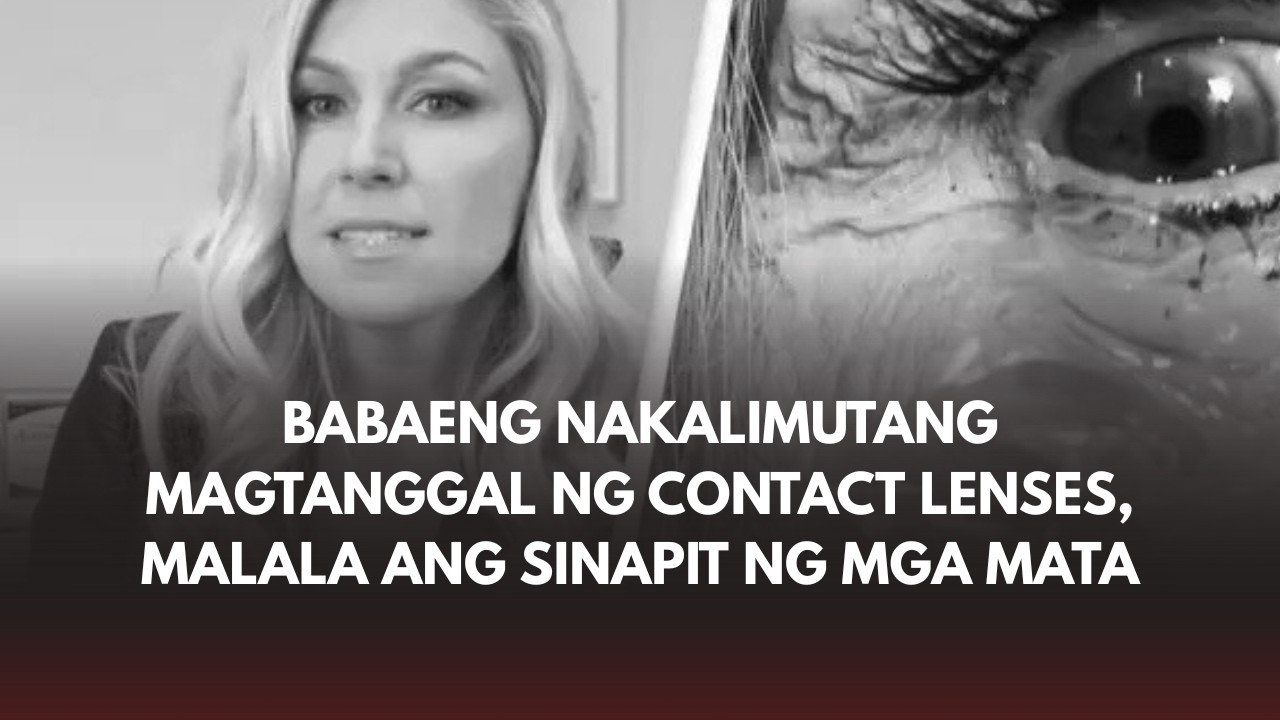 Babaeng nakalimutang magtanggal ng contact lenses, malala ang sinapit ng mga mata