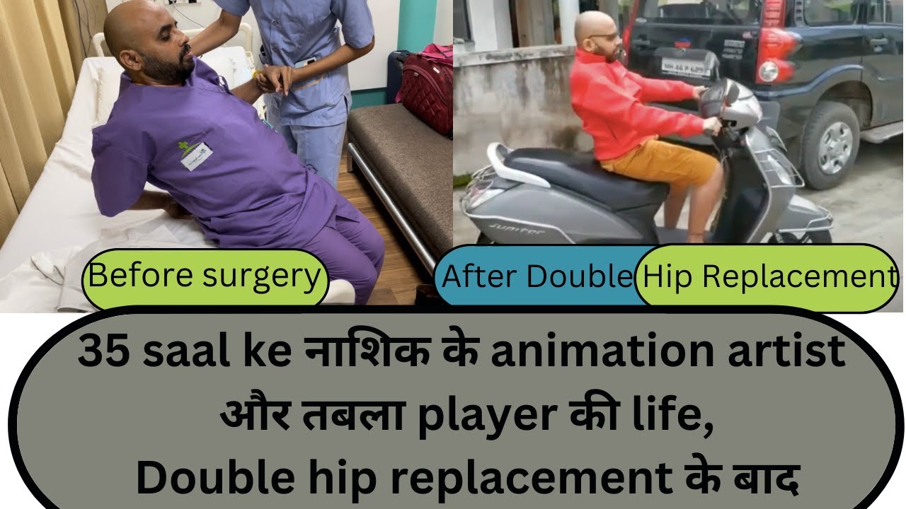 Double hip replacement in fused hips- See how it changes life of a 35 years YOUNG patient