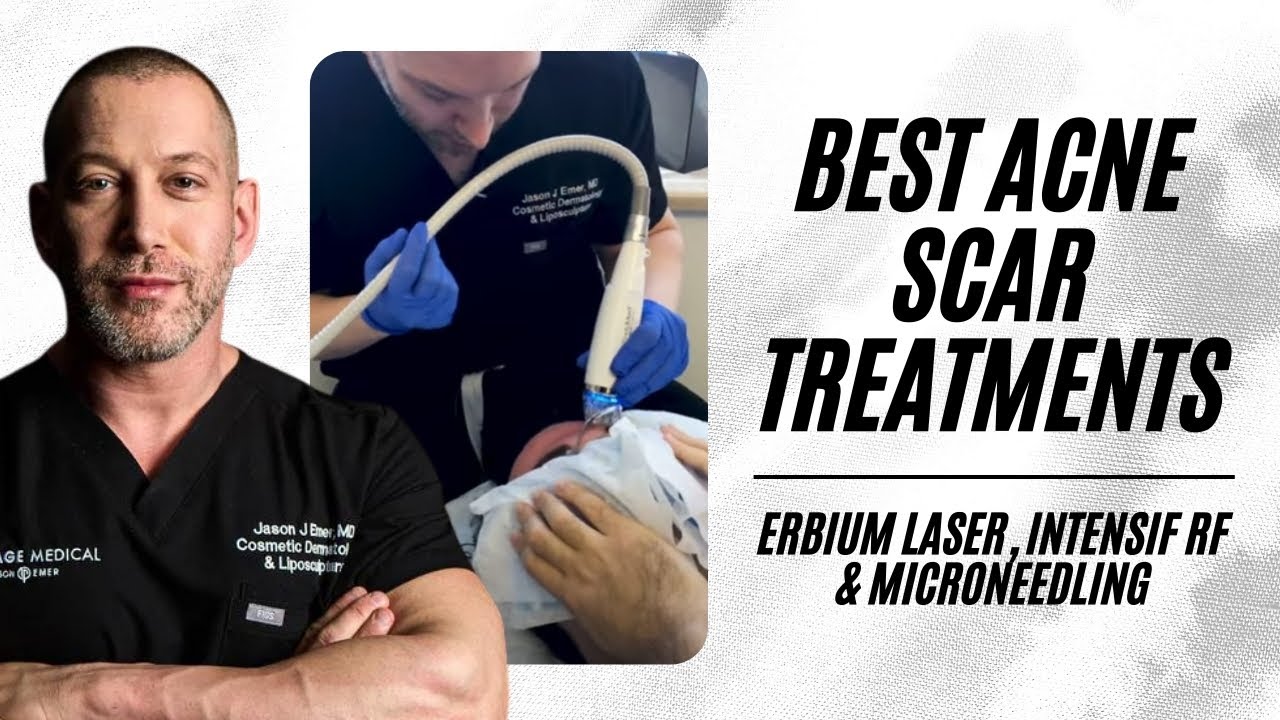 Best Way To Get Rid of Acne Scars | New Technologies 2018 | Erbium | Intensif RF | Microneedling