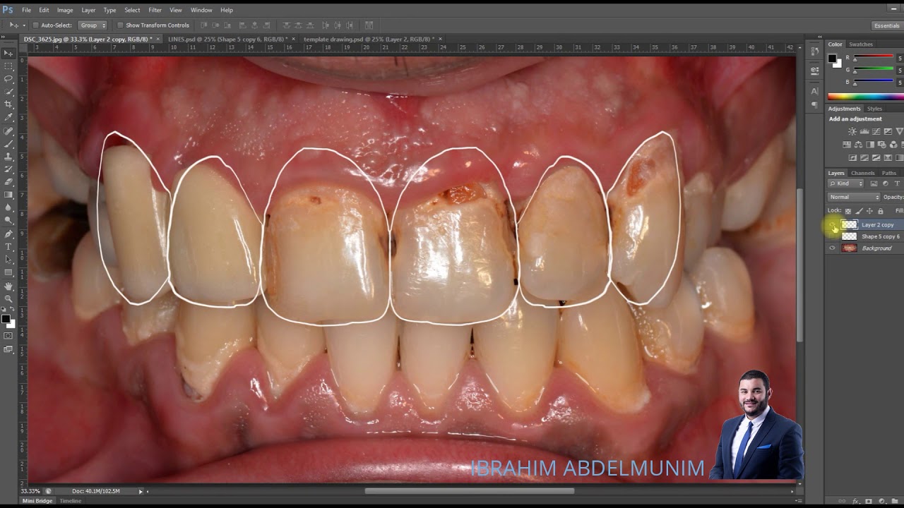 Smile Design
