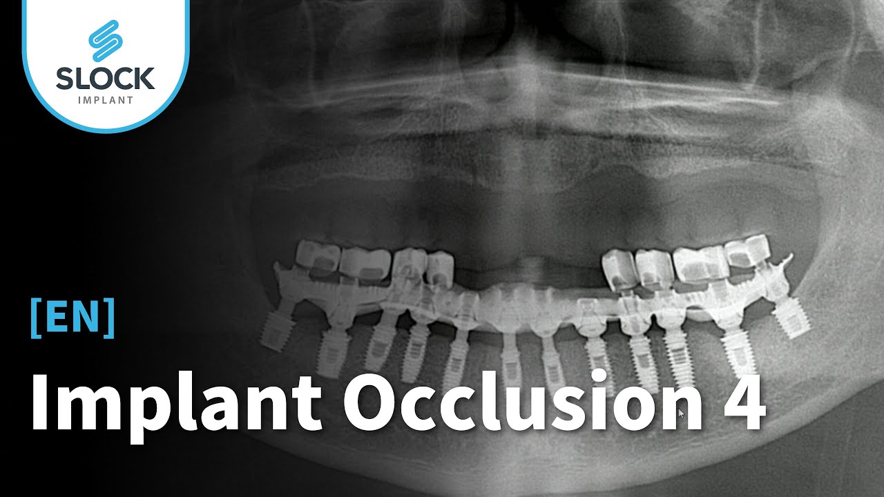 [EN dub / RU sub] Implant Occlusion - 4