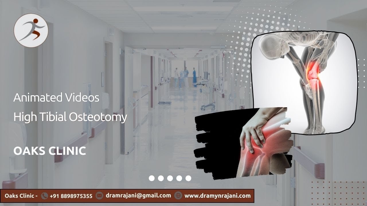 Animated High Tibial Osteotomy Surgery (HTO) | Knee Surgery | Dr. Amyn Rajani | Oaks Clinic
