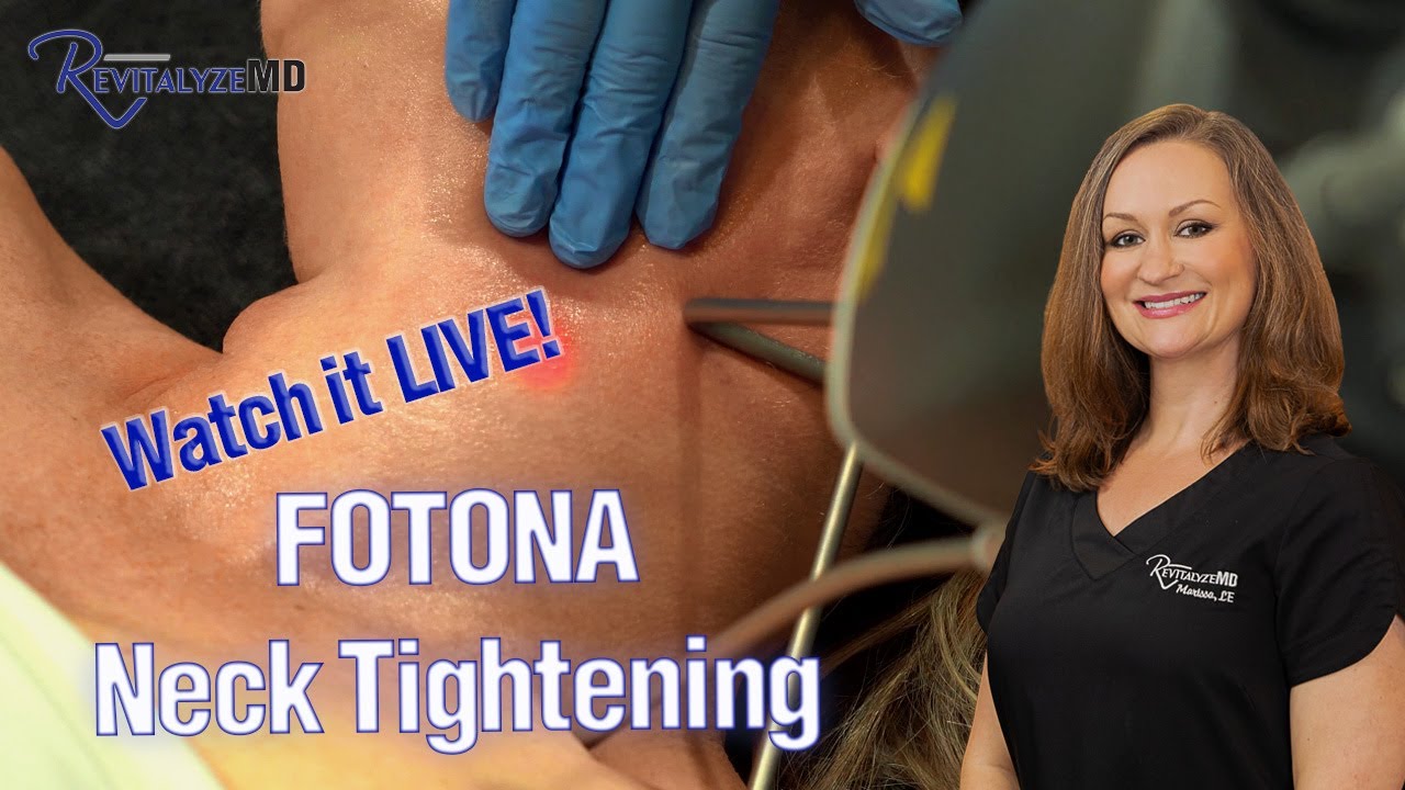 Tighten an aging neck!! | Don't let your neck age you! Lasers are an option for a youthful