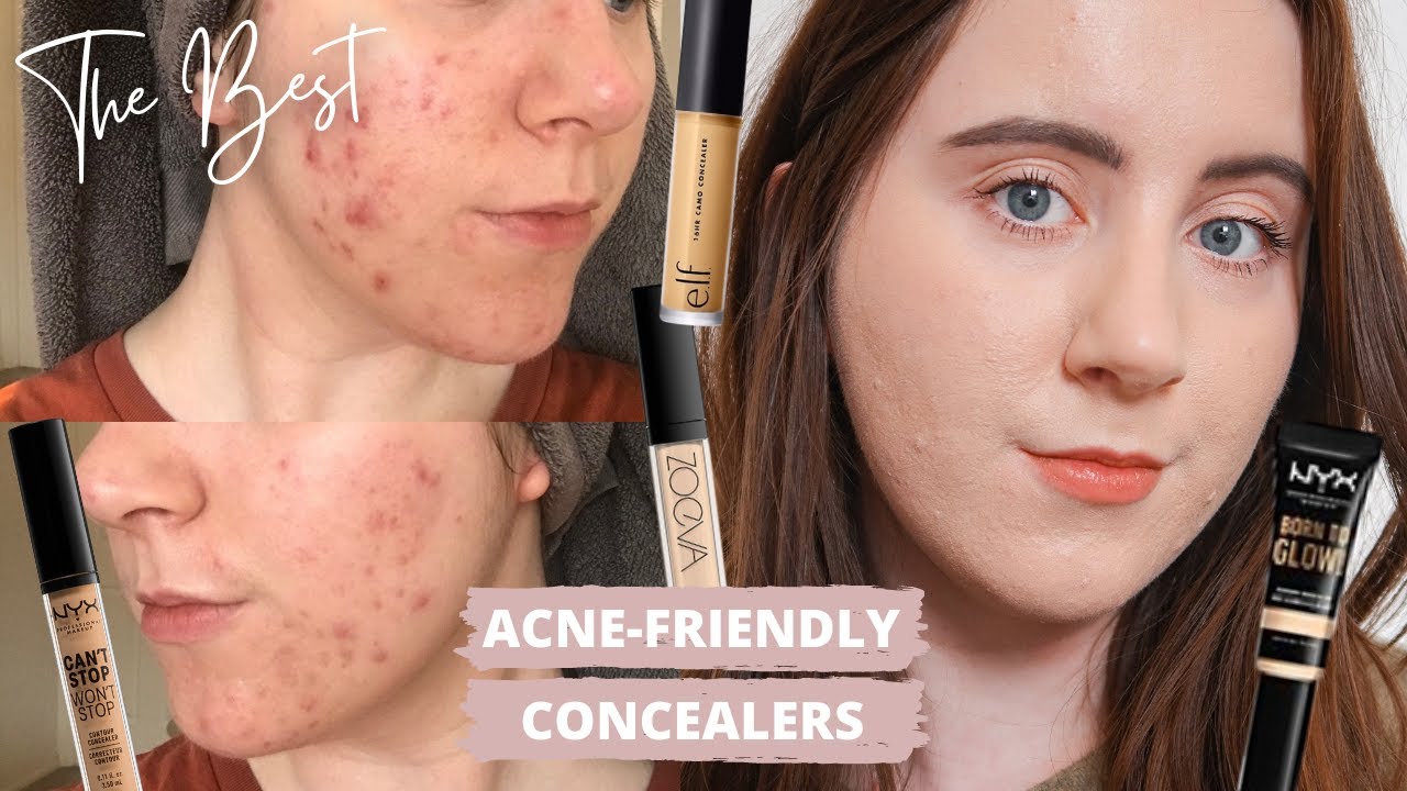 Best Concealers For ACNE PRONE SKIN | Scarring & Pigmentation | Non-Comdogenic