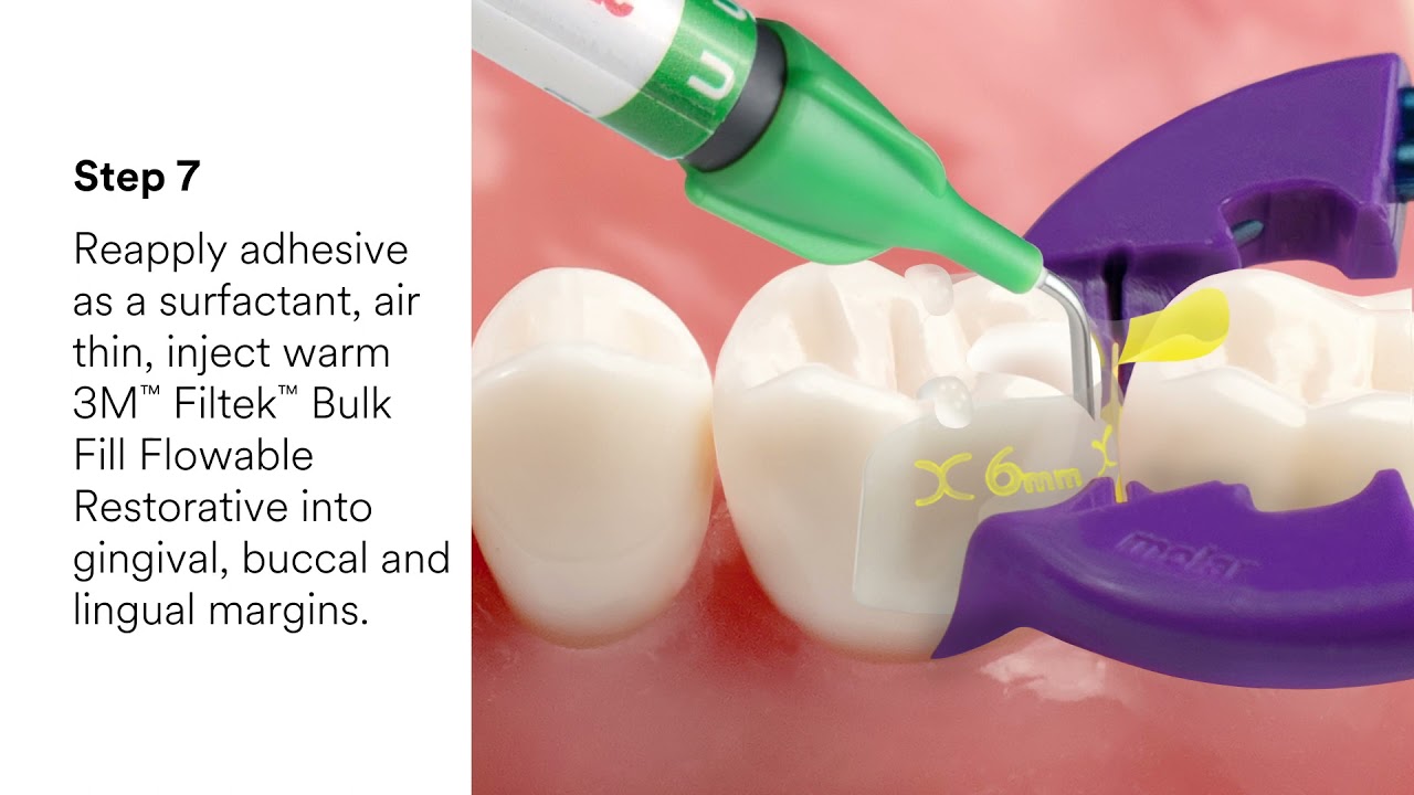Bioclear&trade; Class II Restorations Video