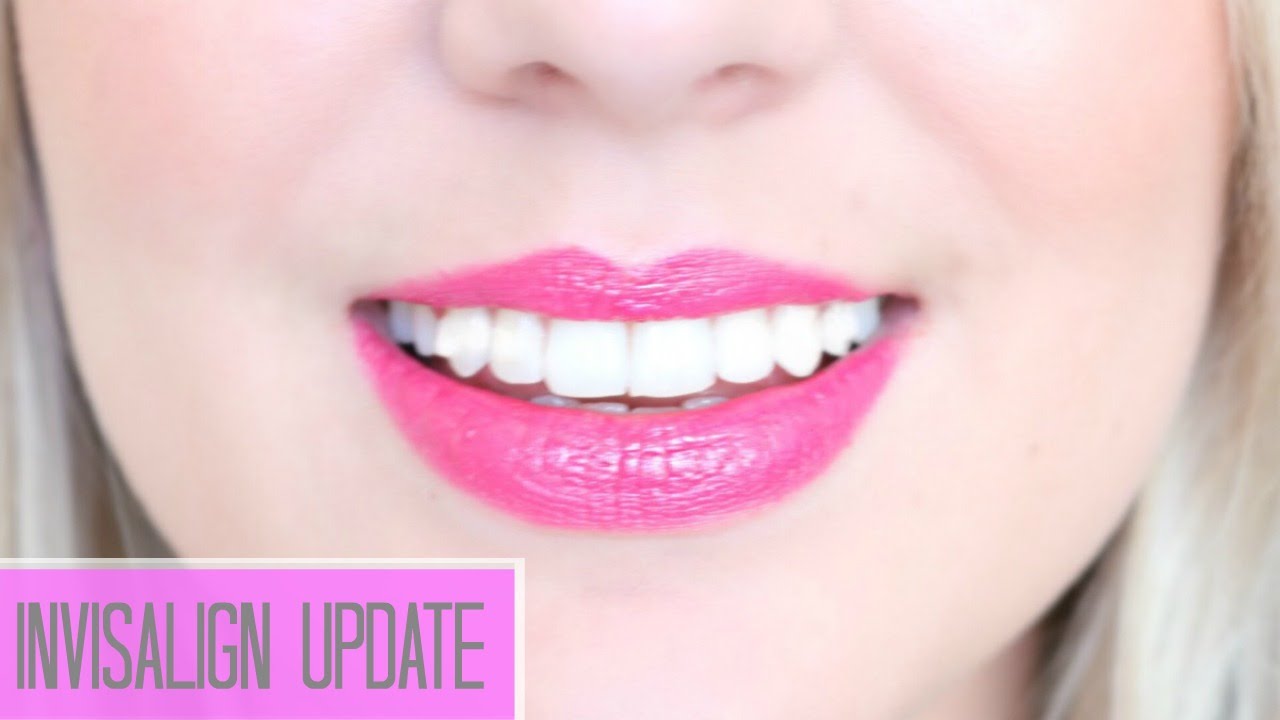 Invisalign update | Bella Coco ad