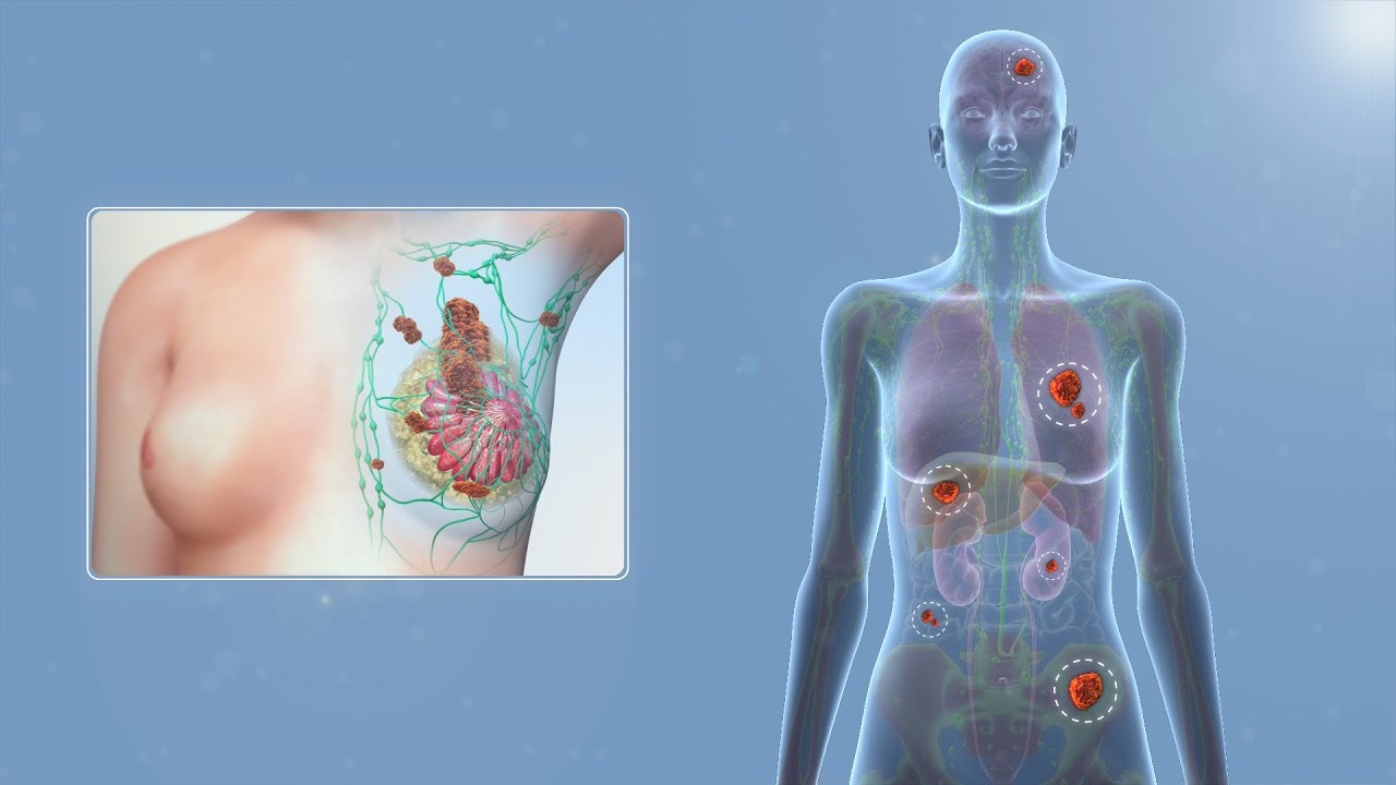 Management of Hormone Positive Metastatic Breast Cancer