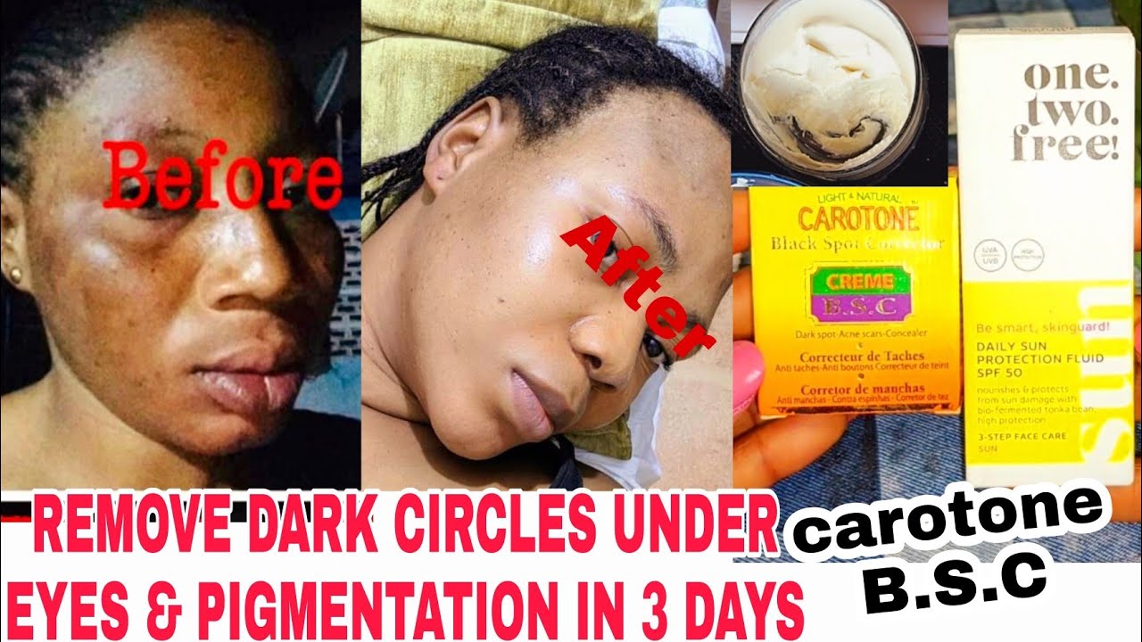 REMOVED DARK EYES CIRCLES IN 3 DAYS WITH CAROTONE & SUNSCREEN CREAM